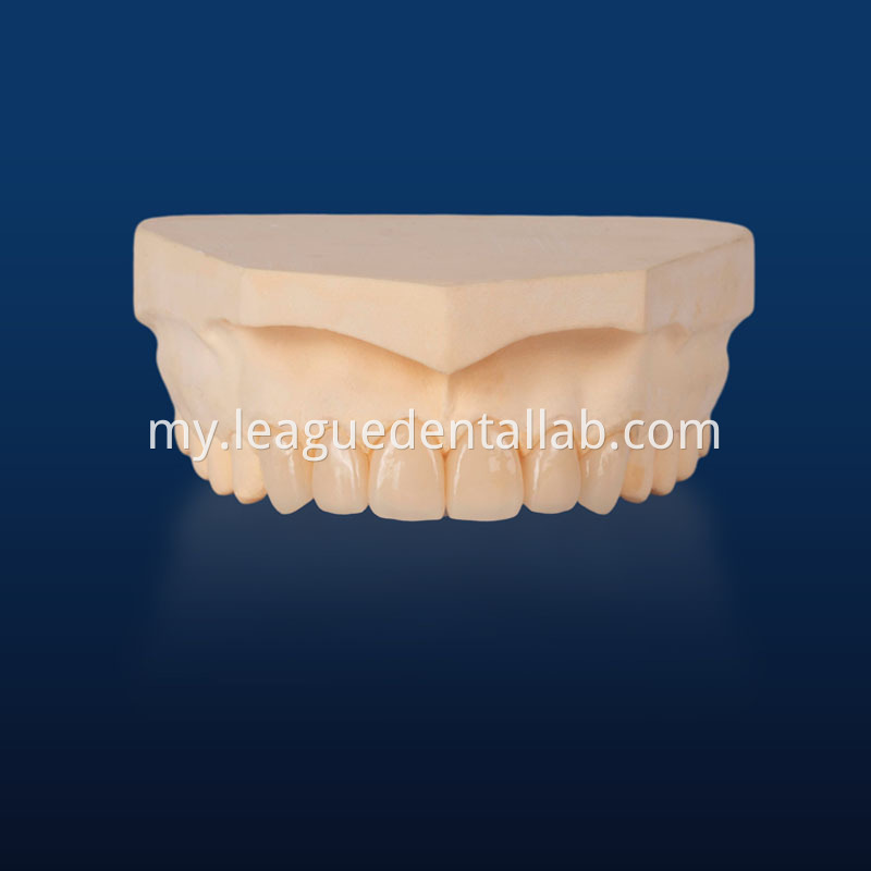 IPS Empress,Emax Onlay,Emax onlay,Emax Veneer,Lithium disilicate